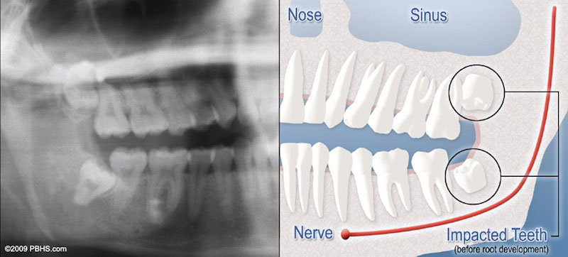 X-ray next to an illustration, showing impacted wisdom teeth in the lower jaw